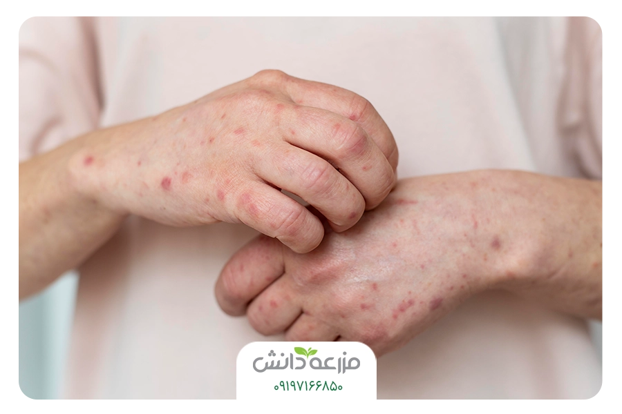 علائم ساس بر روی بدن 
تشخیص گزش ساس